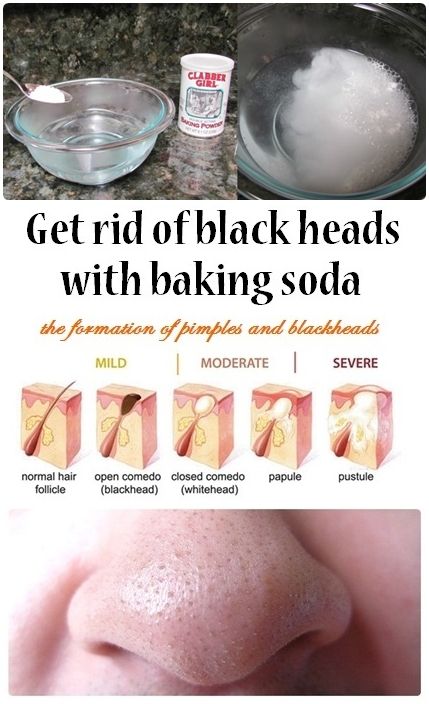 Get rid of Blackheads with Baking Soda DIY