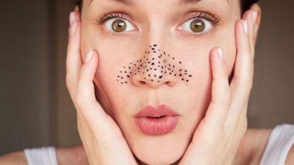 acne blackheads on face