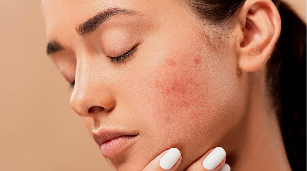 acne remove from skin