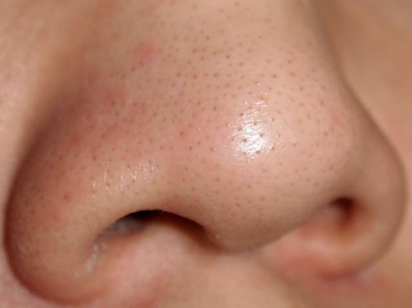 blackheads nose how to remove it