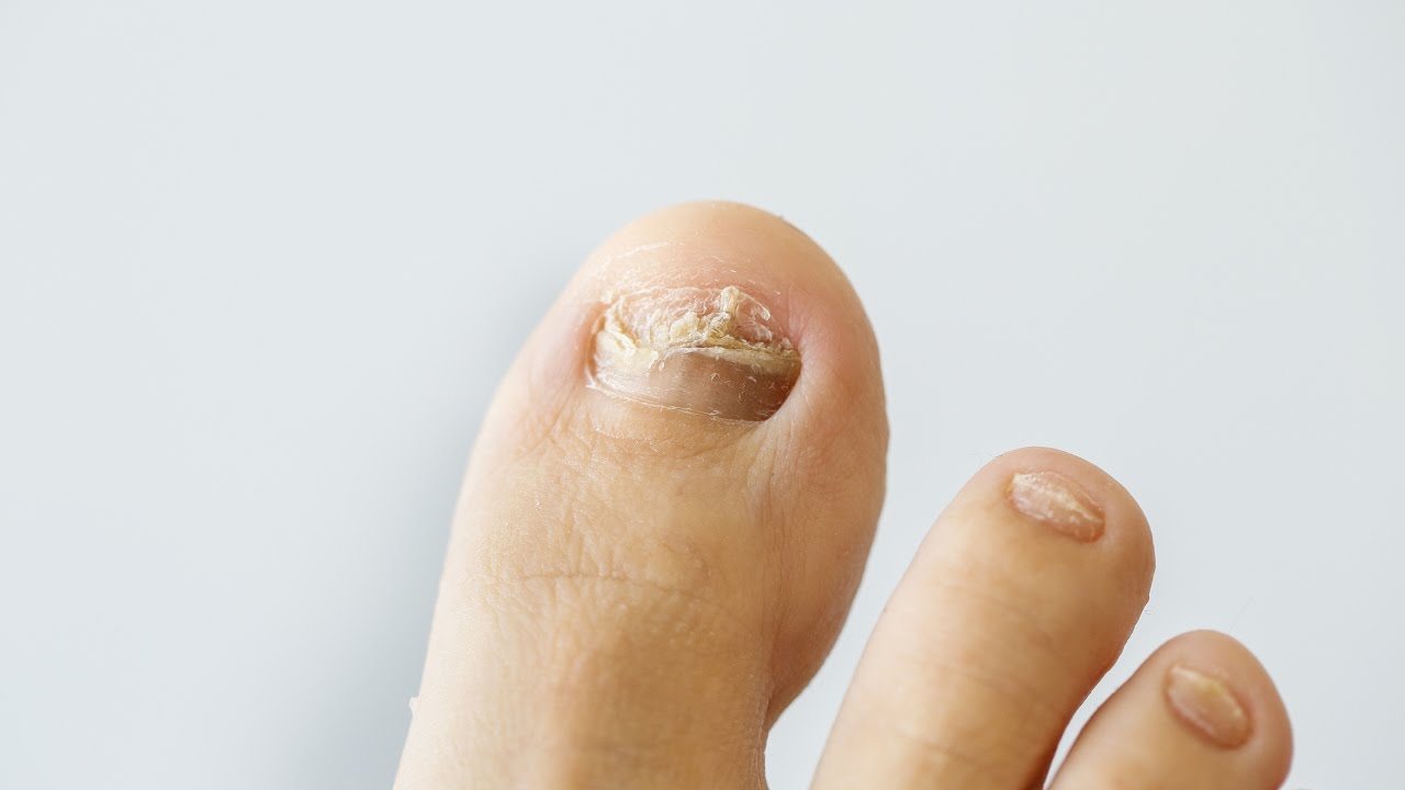 nail fungus