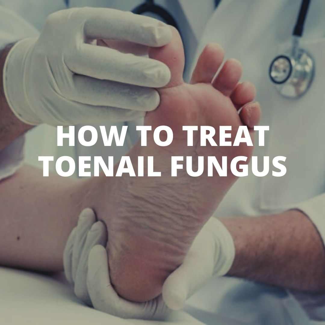 How to treat toenail fungus.