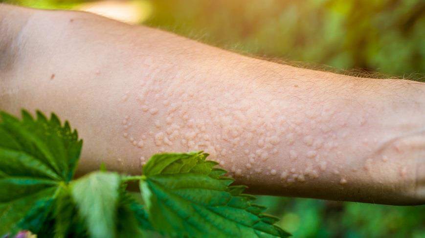 Stinging nettle bites