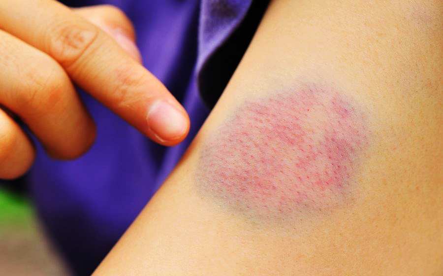 How to get rid of a bruise fast