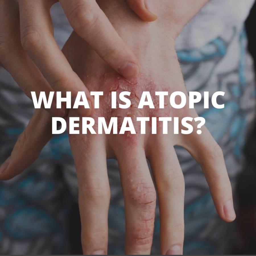 What is atopic dermatitis and what you need to know.