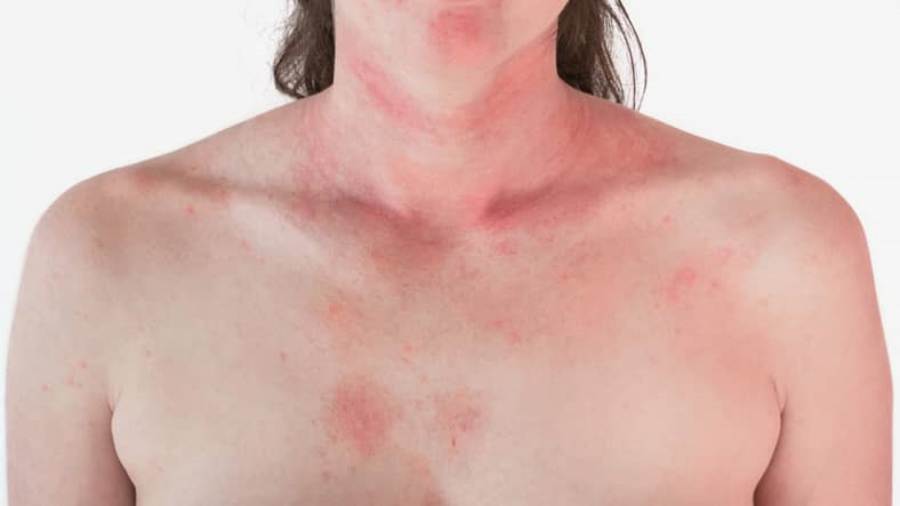 atopic dermatitis 